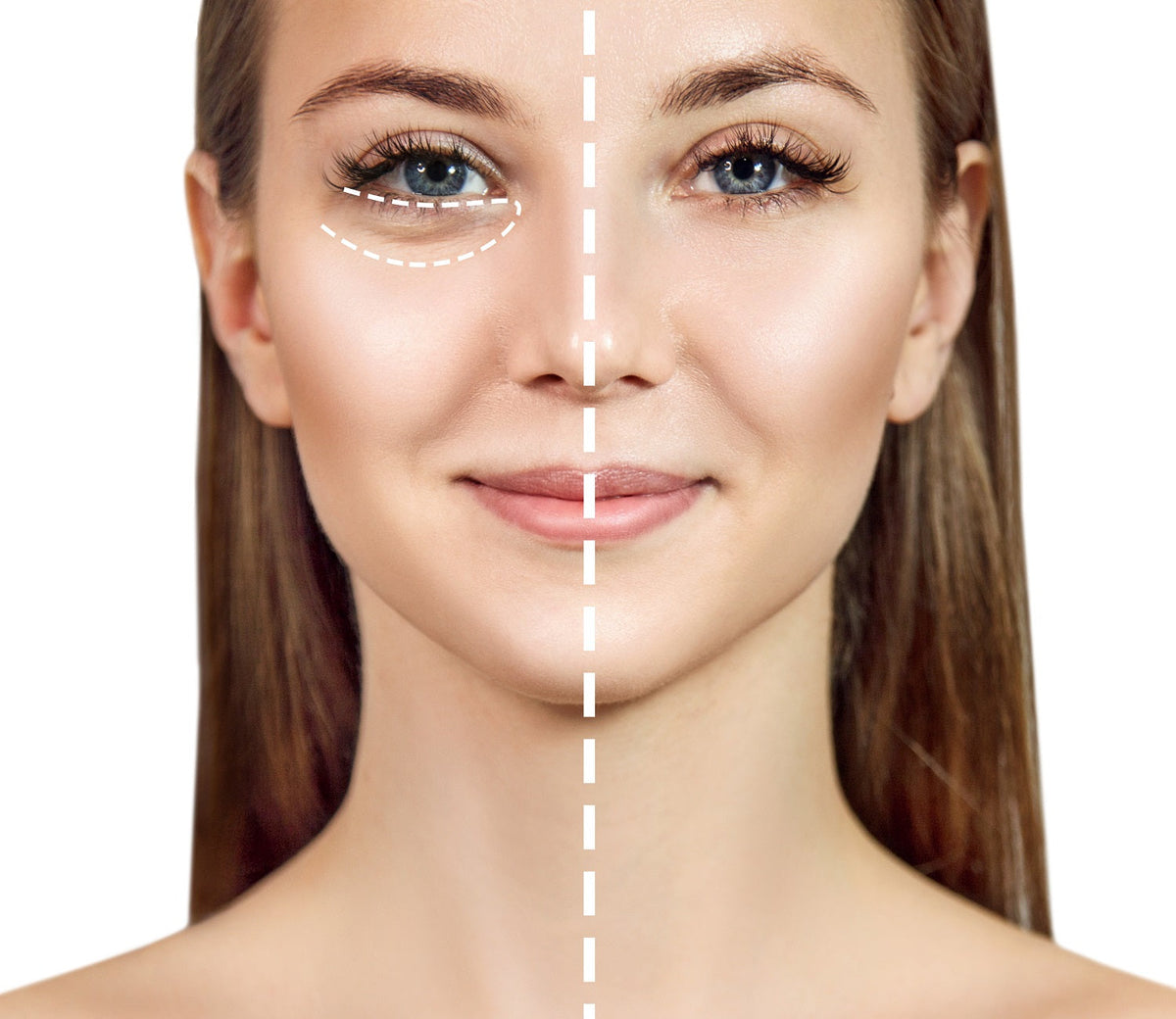 Dark circles and eye bags: why do they form and how to treat them?