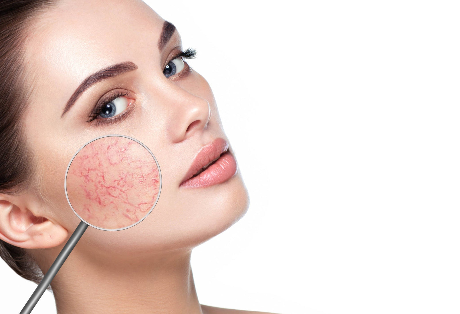 Rosacea: what is it and how to treat it?